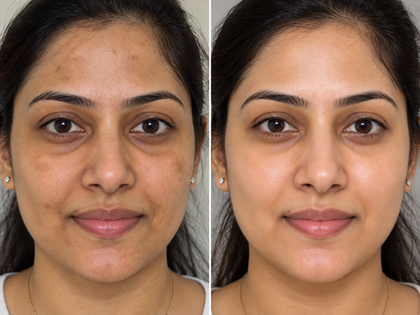 Uneven Skin Tone